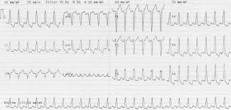 What does svt stand for? Vt Versus Svt Litfl Medical Blog Ecg Library Basics