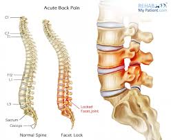 Treatment consists of a simple, usually painless manipulation to unlock the joint. Acute Back Pain Rehab My Patient