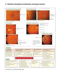 People living with diabetes should have eye screening as part of their diabetes checks. 42 Diabetic Retinopathy Classification And Typical Lesions