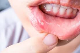 Image result for Canker sores symptoms roof of the mouth