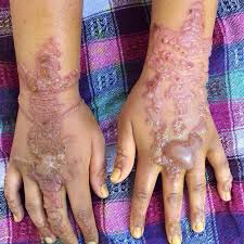 The purpose of this article is to review the literature about allergic reactions to temporary henna tattoos and outline the causes, clinical. 40 Great Concept Black Henna Tattoo Reaction