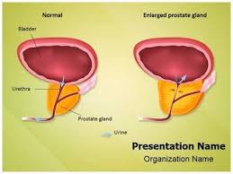 Benign Prostatic Hyperplasia Powerpoint Template Is One Of The Best Powerpoint Templa Powerpoint Templates Benign Prostatic Hyperplasia Powerpoint Presentation