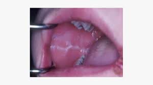Linea Alba In Mouth Causes Treatments And When To See A Doctor