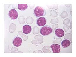 La leucémie myéloïde chronique (lmc) est désormais réellement une maladie chronique qui modifie peu l'espérance de vie dans la majorité des cas. Infocancer Arcagy Gineco Localisations Cancers Du Sang Hemopathies Leucemie Lymphoide Chronique Llc Maladie Une Leucemie