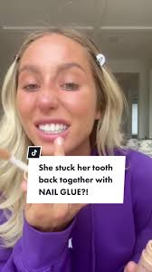 Alix Earle Before Fake Teeth