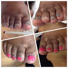 Keryflex Toenail Restoration Instant Results Toe Nails Nails Pedicure