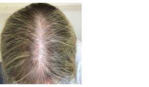 The web reference below discusses dhea levels but i believe you need more than that to find out if you have an identified cause for hair loss. Racgp Female Pattern Hair Loss
