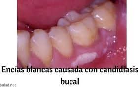 Por Que Me Salieron Unos Granos En El Borde De La Lengua En La Parte De Atras Y Las Encias De Abajo Tienen Manchas Blancas Medicina Todoexpertos Com