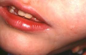 Drooling, or slobbering, is the flow of saliva outside the mouth. Http Oscarpd Ro Webapp Uploads 5fbc206672077 Drooling Pdf