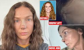 New photos show killer yoga teacher Kaitlin Armstrong recovering from  plastic surgery in Costa Rica, after murdering boyfriend's 'lover' Moriah  Wilson in Texas