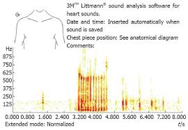 spectral analysis of bowel sounds in intestinal obstruction