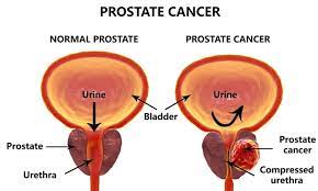 One in seven men in the united states will receive a prostate cancer diagnosis during his lifetime. Theresa May To Launch 75m Drive Against Prostate Cancer