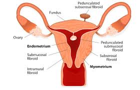 They usually grow slowly — or not at all — and tend to shrink after menopause, when. My Uterine Fibroid Tumor Story Energetic Nutrition