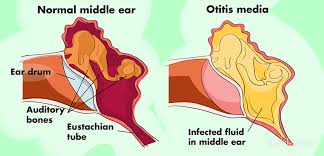 A drop or two of olive oil in each ear can help . Sweet Oil And Other Home Remedies For Painful Ear Infections Remedygrove