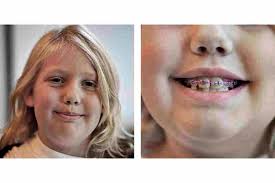 Decoding The Dental Braces Cost In Noida