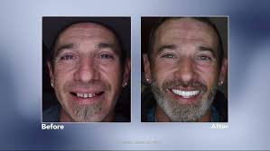 Replacing Missing Teeth with Dental Implants