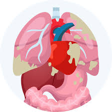 This is, however, just a statistic; Stages Of Mesothelioma Mesothelioma