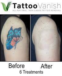 8 treatments at $250 each over 27 months. Before And After Tattoo Removal Get The Best Results The All Natural Way Tattoo Removal Pictures Tattoo Vanish