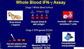 Tuberculosis using whole blood specimen. Understand The Significance Of Quantiferon Tb Gold Test