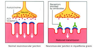 Understanding Myasthenia Gravis Understanding Myasthenia Gravis Myasthenia Asia