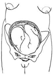 Image result for Shoulder Presentation