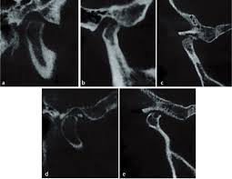 Association between Condylar Bone Changes and Eichner Index in Patients  with Temporomandibular Dysfunction: A Cone Beam Computed Tomography Study