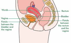 What does a tumor feel like under the skin? What Is A Fistula Signs And Symptoms Macmillan Cancer Support