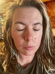 Chemical Peel Treatment for Texture and Hyperpigmentation Correction in  Livingston