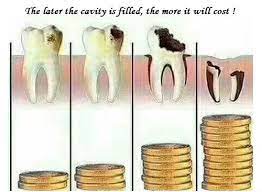 How To Handle Large Cavities Cavities Dental Caries General Dentistry