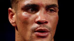 Two years ago today I suffered the worst injury of my life, an eye socket  that had “exploded” as one doctor eloquently put it to me. Multiple  fractures sustained as well as