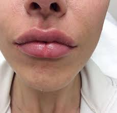 Rajouter un lien externe vers une page web. Injections Aux Levres 8 Choses A Savoir Avant De Se Faire Grossir Les Levres