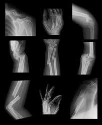 Image result for Fracture