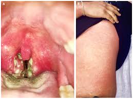 Image result for Scarlet Fever
