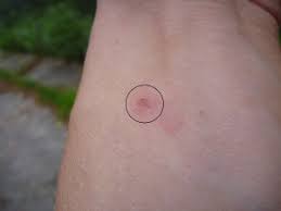 Image result for große winkelspinne biss haut reaktion