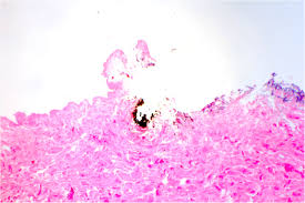 A gunshot wound (gsw) is physical trauma caused by a projectile from a firearm. Pathology Outlines Gunshot Wounds