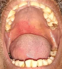 Image result for Physical injury red spots roof of mouth