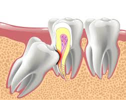 Check spelling or type a new query. Affordable Wisdom Teeth Removal In Houston Ismile Specialists