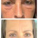 Malcolm A. Lesavoy, MD, FACS, Board Certified Plastic Surgeon