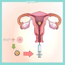 In vitro fertilization (ivf) with embryo transfer, is one of the most effective fertility. Top 5 Embryo Transfer In Malaysia Price Guide Reviews