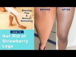 17 How To Get Rid Of Strawberry Legs Fast Like A Boss Easy Regimen At Home Remedies Youtube Strawberry Legs How To Remove Pimples Good Skin