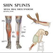 Image result for Tibia Stress Fracture