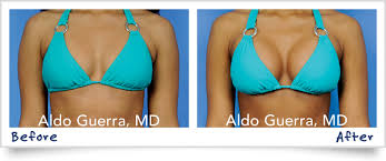 Image result for Breast Augmentation