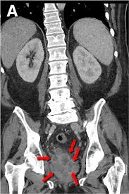 Check spelling or type a new query. What Are The Symptoms Of Prostate Cancer Ida International