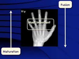 Bone Age Made Easy