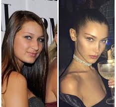Bella Hadid Before And After Cirujia De Nariz Cirugias De Nariz Operacion De Nariz