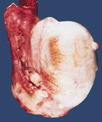 Testicular mesothelioma is the rarest form of the already rare cancer. Pathology Outlines Mesothelioma