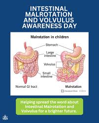 Image result for Intestinal Malrotation