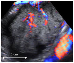 N engl j med 1990; Diagnostics Free Full Text 4d Doppler Ultrasound In High Grade Serous Ovarian Cancer Vascularity Evaluation Preliminary Study Html