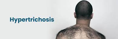 Image result for Hypertrichosis