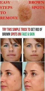 How To Get Rid Of Brown Spots On Face And Hands Howtogetridofacnescars Beautyhacksface Spots On Face Brown Spots On Face Brown Spots On Skin